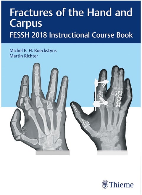 Fractures of the Hand and Carpus: Fessh 2018 Instructional Course Book