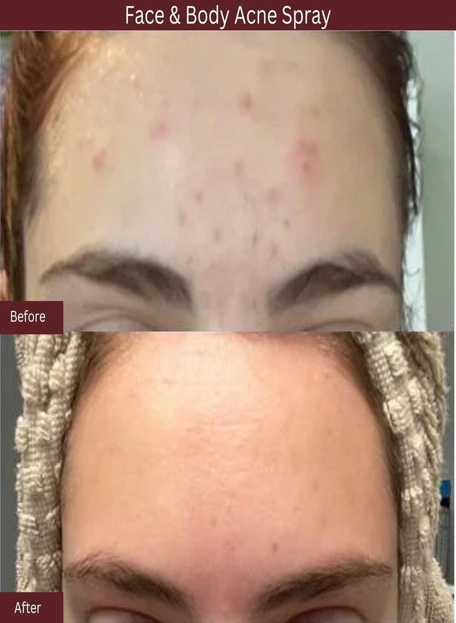 ITK Skincare 2% Salicylic Acid Spray for Face & Body Acne - Blemish-Fighting Treatment for Body Acne, Bacne, Blackheads, Pimples & Blemishes - BHA Blemish Facial Mist Post Workout - 3.3oz Spray Bottle - Image 3