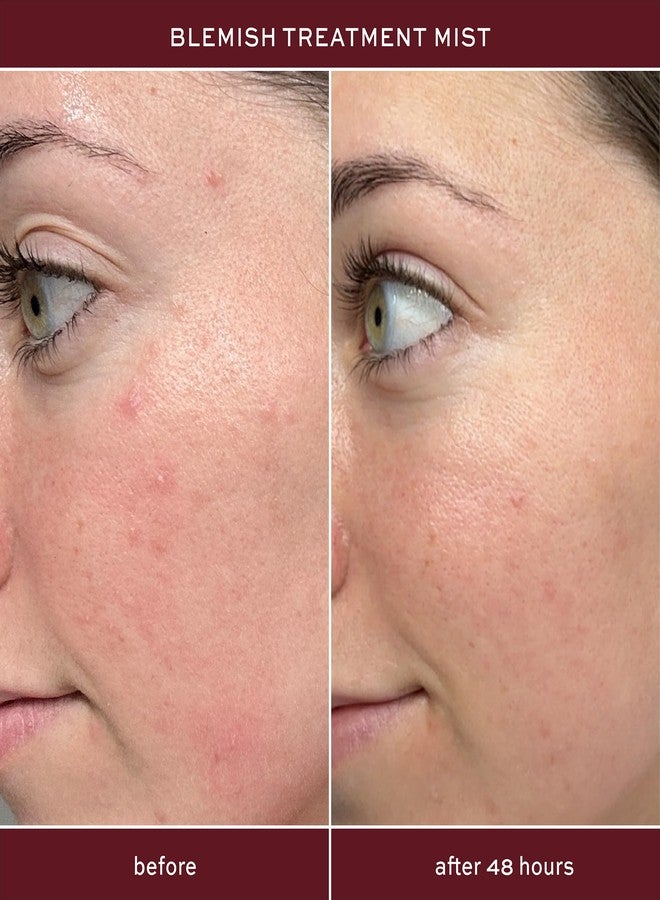 ITK Skincare 2% Salicylic Acid Spray for Face & Body Acne - Blemish-Fighting Treatment for Body Acne, Bacne, Blackheads, Pimples & Blemishes - BHA Blemish Facial Mist Post Workout - 3.3oz Spray Bottle - Image 2