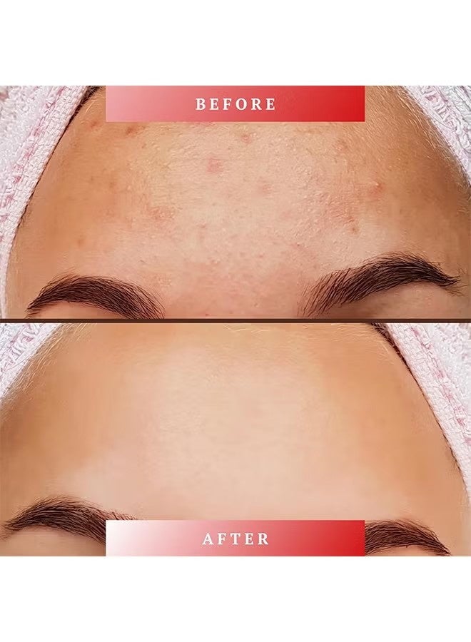 FUSHITING Azelaic Acid 15% Acne Tratment Cream, Acne Cream for Face, Spot Treatment, Anti Acne Gel For Spot Prone Skin, Rosacea Reducing Relief Pimple Breakouts Blackhead Pigmentation and Redness,Hydrate 15g - Image 2