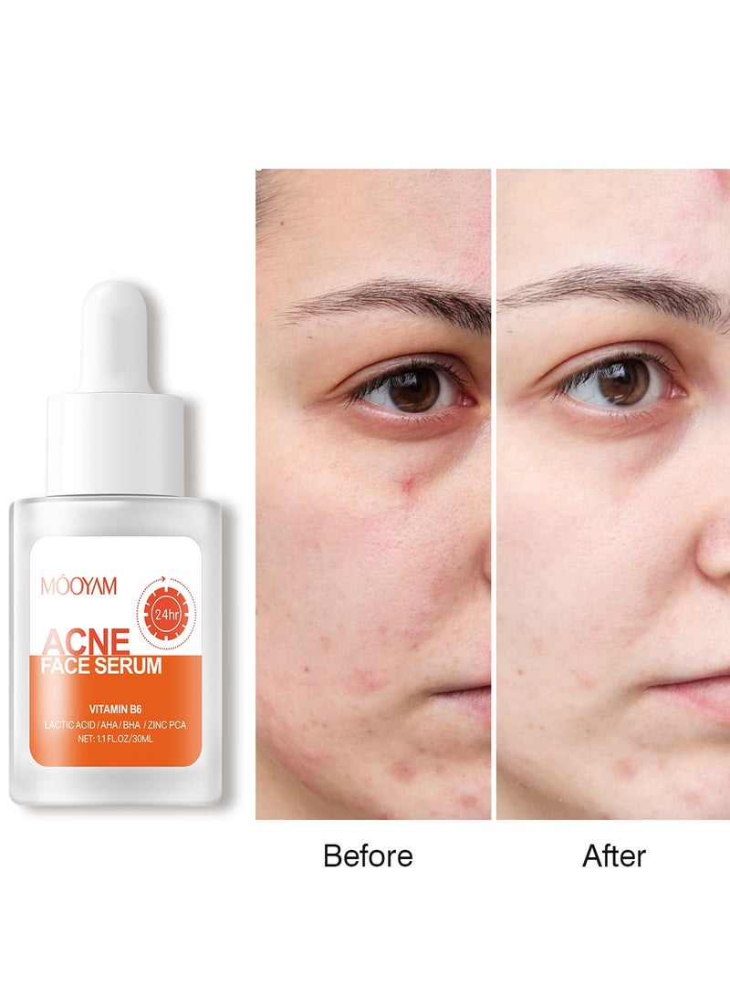 MOOYAM Salicylic Acid Face Serum 30ml - Skin Clearing Treatment for Acne, Blackheads & Pores - Oil Control & Exfoliating Serum for Clear, Smooth Skin  - Image 2