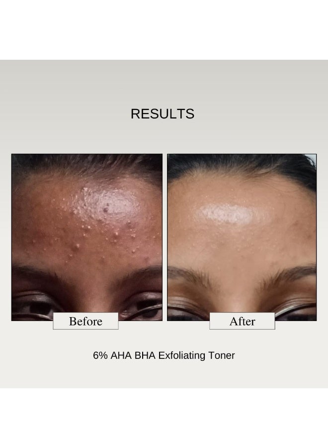 The Formularx 6% Aha Bha Exfoliator(5% Glycolic & 1% Salicylic Acid)Exfoliating Serum For Whiteheads,Enlarged Pores,Dark Spots|Brightens & Smoothens Texture|For Oily,Combo,Acne Prone Skin 100 Ml - Image 4