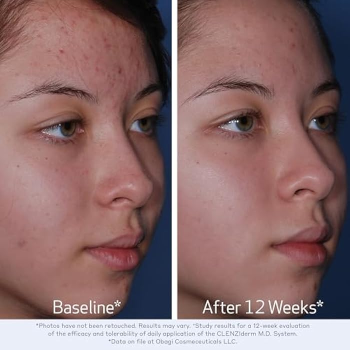 Obagi Medical Obagi CLENZIderm M.D. Daily Care Foaming Acne Cleanser – Acne Treatment with 2% Salicylic Acid (BHA) - Image 3