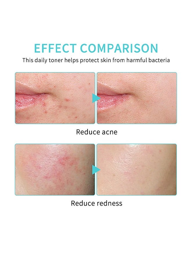 lakerain Daily Rescue Facial Spray,Facial Toner with Pure Hypochlorous,Face and Skin Renew Toner Spray,Moisturising Spray for Sensitive Skin,Acid Hypochlorous Acid Spray-30ml  - Image 5