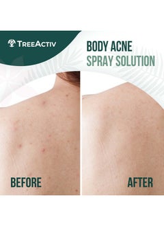TreeActiv Salicylic Acid Back & Body Acne Spray, Back Acne Solution For Women And Men, Acne Body Spray With Tea Tree Oil, Fast-Drying Back Acne Spray, Fine Mist, Back Acne Treatment Spray, 4 Fl Oz, 2-Pack  - Image 1