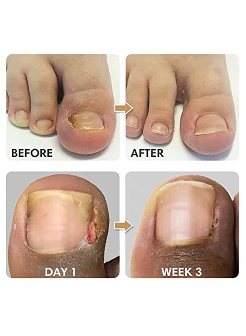 EELHOE 50 قطعة من ملصقات تصحيح أظافر القدم، شرائط تصحيح أظافر القدم الغارزة، ملصقات دعامة مرنة لأظافر القدم - Image 4