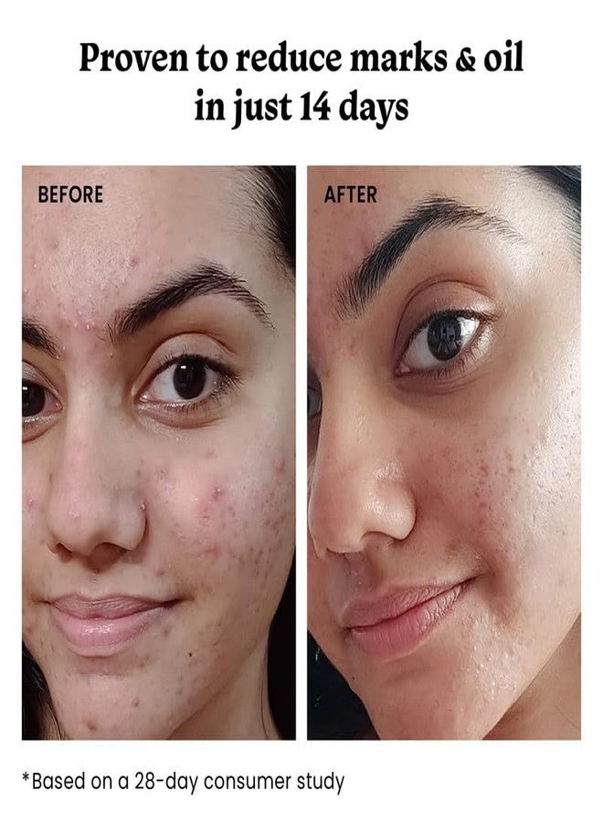 Foxtale Oil Control Duo | 12% Niacinamide Clarifying Serum + Oil Balancing Moisturizer | Targets 7 Signs of Acne | Oil-Free Glow, Smoother Texture | With Azelaic Acid, Niacinamide & Cica - Image 4