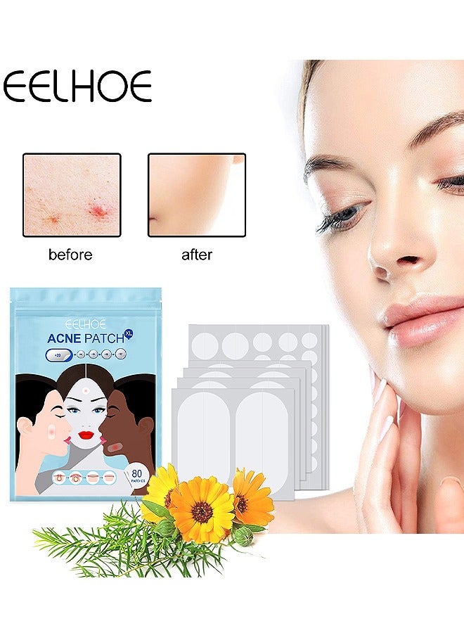 EELHOE Acne Pimple Patches, 5 Sizes 80 Patches For Large Zit Breakouts, Acne Patches For Face, Chin Or Body, Acne Spot Treatment With Tea Tree And Calendula Oil, Hydrocolloid Bandages For Acne Skin - Image 1