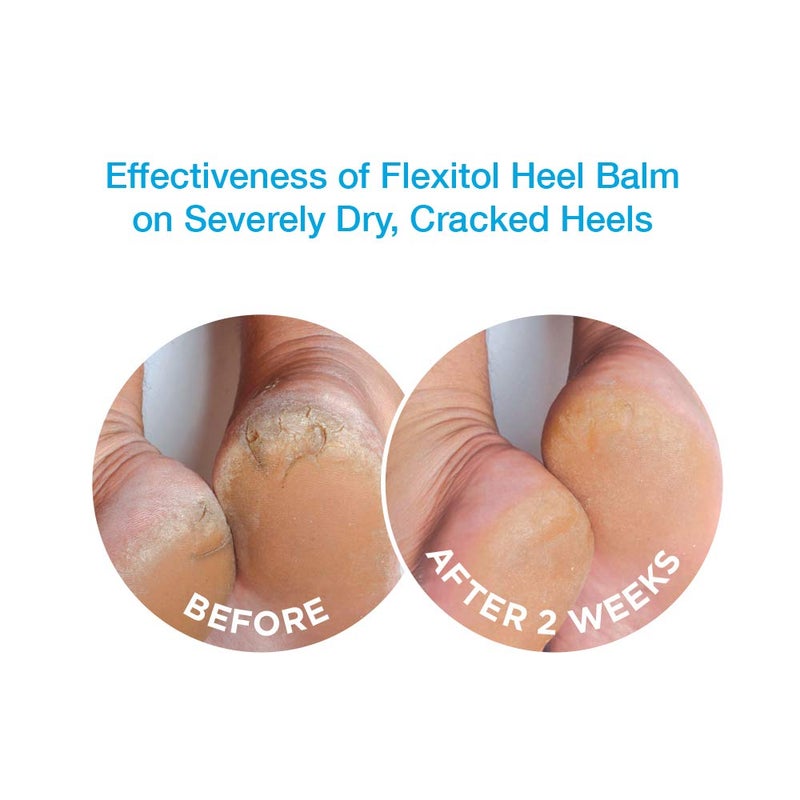 Flexitol Heel Balm 4 Oz Tube (Pack of 2), Rich Moisturizing & Exfoliating Foot Cream. Fast Relief of Rough, Dry & Cracked Skin on Heels/Feet. For Daily Use and Pedicures. Diabetic Safe and Effective - Image 2