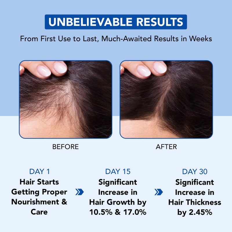 Botanic Hearth زيت إكليل الجبل النقي بنسبة 100% من بوتانيك هيرث لنمو الشعر، غني بالبيوتين | علاج لتقوية الشعر | مغذي ومكثف | بزيت الجوجوبا وزيت الخروع | خالٍ من الكائنات المعدلة وراثيًا | 6.7 أونصة سائلة - Image 3