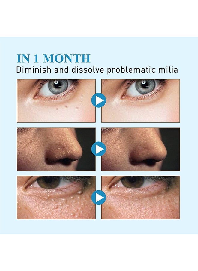 144 Pcs Milia Remover Patch,Remove Fat Granule Eye Patch, Remove Oil Granule Eye Patch Under The Face, Nourish Eye Cream, Moisturize Repair and Smooth Eye Patch