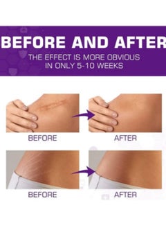 HBESTY Silicone Scar Gel, Scar Cream, Scar Gel, Acne Scar Treatment, Deep Acne Scar Removal, Burns Keloids Hypertrophic, Scar Removal Cream, Repair Damaged Skin, Removing Acne Marks, Scar Repair Cream  - Image 5