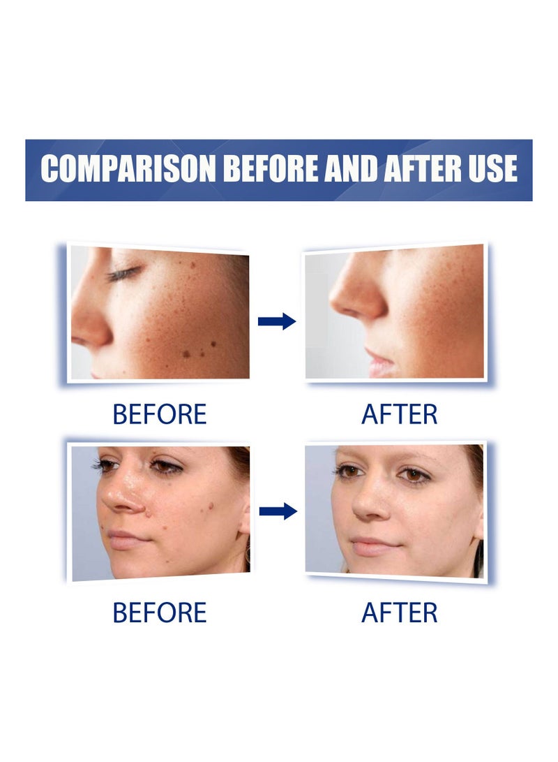 EELHOE 20g Warts Remover Cream Extract Skin Face Tag Extract Corn Treatment Ointment Painless For Men Women Childrens 100g each (Pack Of 2) - Image 4