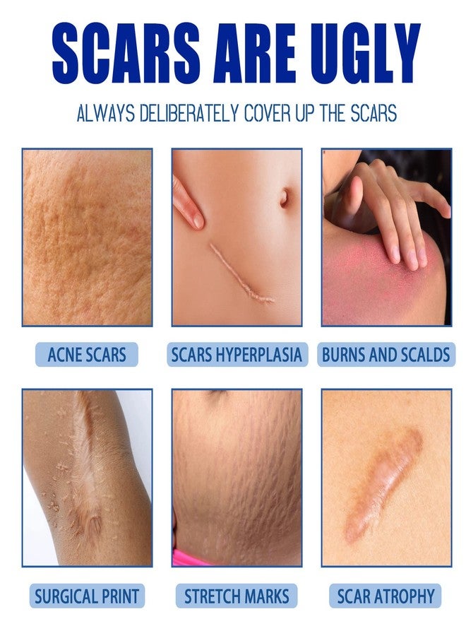 EDVKLNG Scar Cream For Men And Women, Repair Skin Scar Cream,Facial Advance Silicone Removal Scar Gel Away Gel For Surgical Scars (2pcs - Image 2