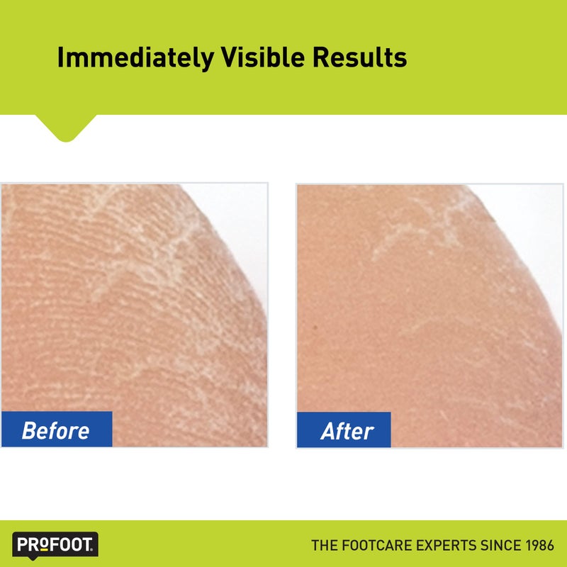 ProFoot كريم القدم بروفوت هيل ريسكيو 16 أونصة، عبوة 2، للبشرة المتشققة أو المتصلبة أو المتشققة - Image 4
