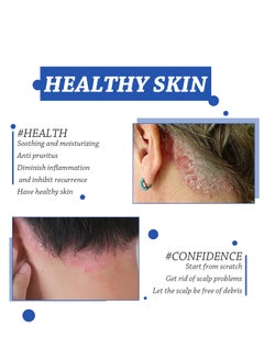 SOUTH MOON Scalp care cream,cream For Scalp Prone To Folliculitis, Dermatitis, Dandruff, Mites, Itchy And Flaky Scalp, Treats Dandruff And Seborrheic Dermatitis  - Image 4