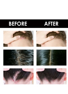 SOUTH MOON Scalp care cream,cream For Scalp Prone To Folliculitis, Dermatitis, Dandruff, Mites, Itchy And Flaky Scalp, Treats Dandruff And Seborrheic Dermatitis  - Image 3