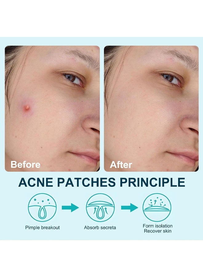Acne Patch Pimple Patch, 6 Sizes 150pcs Invisible Acne Patches Absorbing Cover Patch for Face Zit Patch, Hydrocolloid Acne Stickers for Covering Zits Blemishes - Image 3