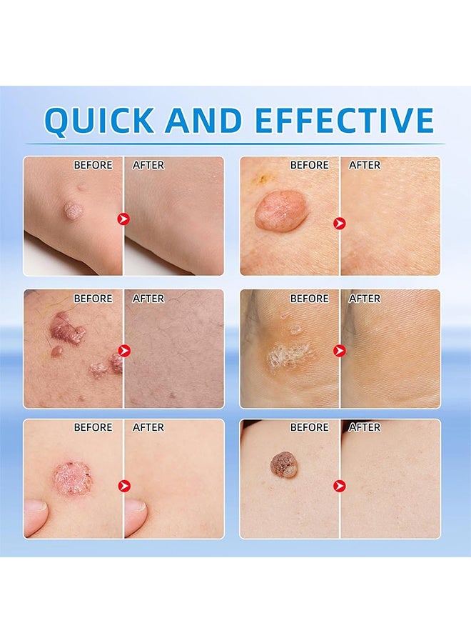 DERMFREE Liquid Wart Corn & Callus Remover 30ml, Fast Action Wart Remover Warts Removal Liquid with Salicylic Acid Remove Plantar Warts Common and Flat Wart Feet Corn Callus Treatment Liquid  - Image 4