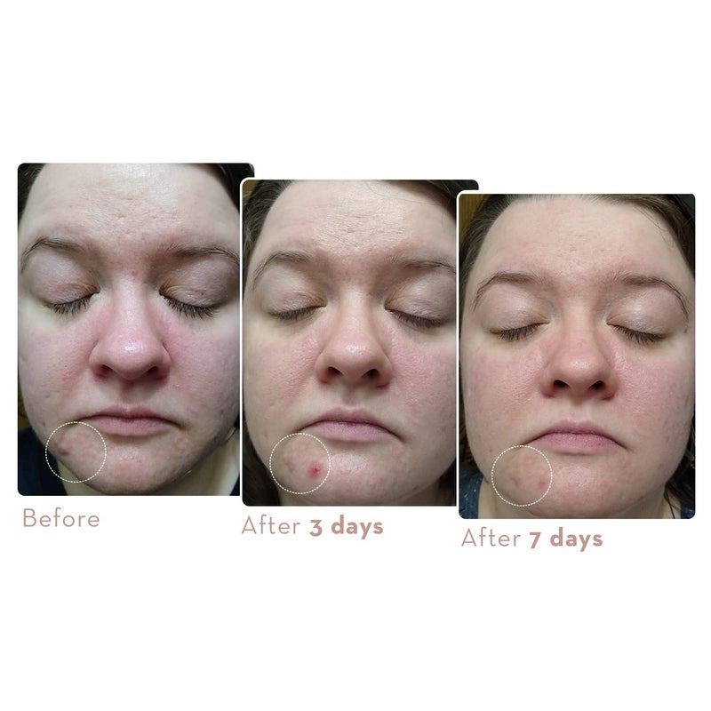 Sonage Zitlox Salicylic Acne Gel: Spot Treatment with Tea Tree Oil | Clears Acne Blemishes | Benzoyl Peroxide Alternative - Image 5