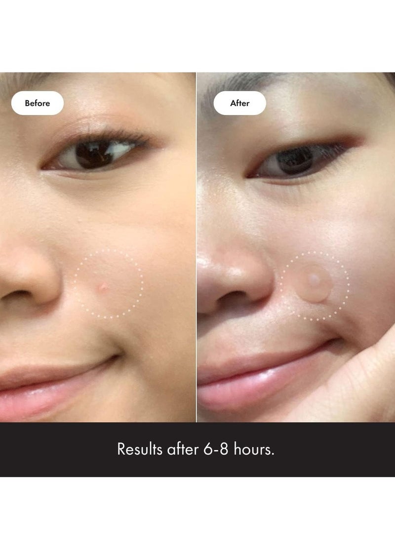 Mighty Patch Hydrocolloid Acne Pimple Patch Spot Treatment 36- Piece  - Image 3