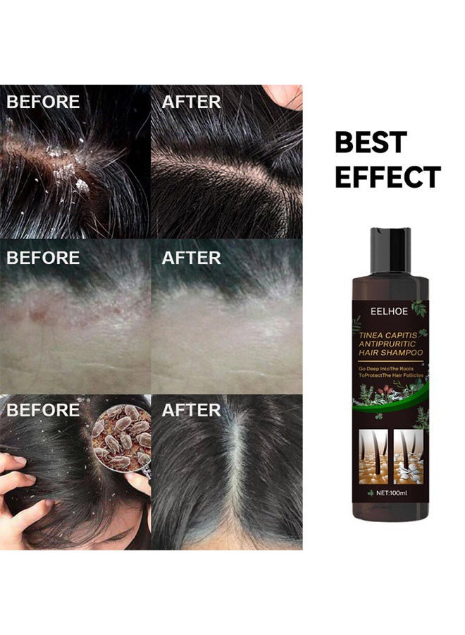 EELHOE Tinea Capitis Antipruritic Hair Shampoo, Anti-Dandruff Shampoo, Shampoo For Scalp Prone To Folliculitis, Dermatitis, Dandruff, Mites, Itchy And Flaky Scalp, Treats Dandruff And Seborrheic Dermatitis - Image 2