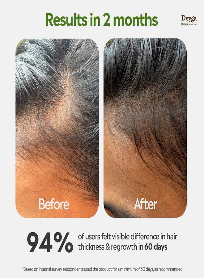 Deyga Hair Growth Oil | Promotes Hair Growth | Reduces Hairfall | Repairs Damaged Hair | Makes Hair Soft & Smooth | Infused with Hibiscus, Rosemary & Grapeseed Oil (100ml Hair Growth Oil) | Suits Men and Women - Image 2