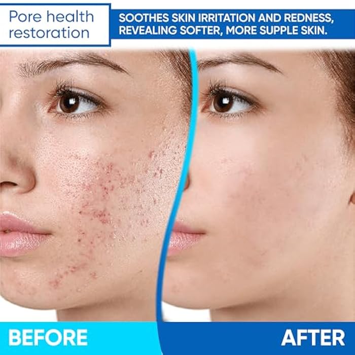 Aobbiy Azelaic Acid Cream: Azelaic Acid For Face - Premium Azelaic Acid Cream - Face Skin and Beauty Care - Azelaic Acid Facial Cream (1 Oz) - Image 5