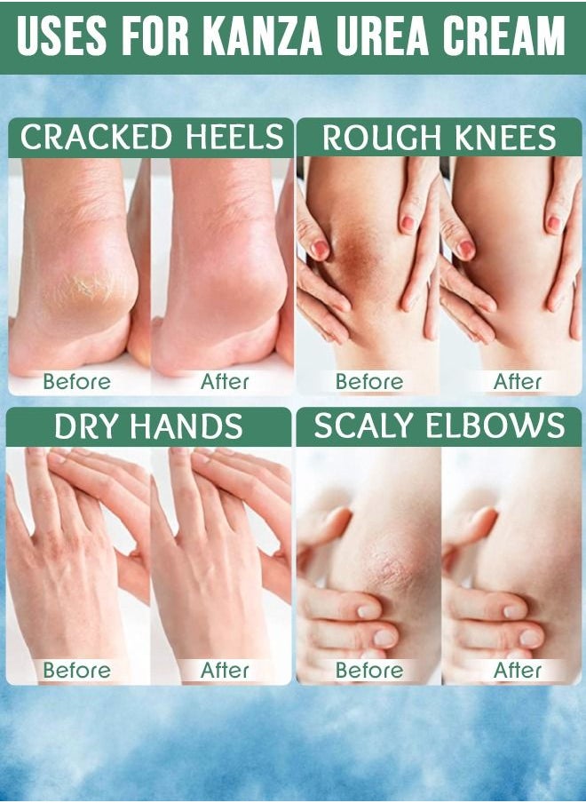 Kanza - 40% Urea Cream for Cracked Feet Hands 150g Callus Remover Hand Cream Foot Cream for Cracked Foot Heels Elbows Nails Knees Skin Moisturizer Urea Lotion with Maximum Strength for Men and Women - Image 1