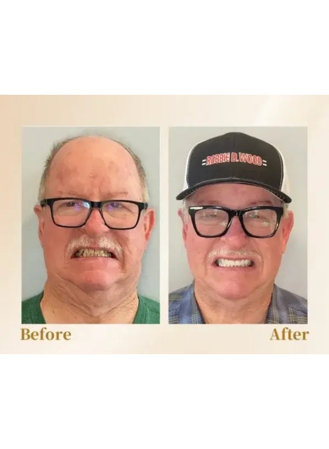 Feimuko Comfortable Fit, Natural Look, Easy Care - Professional Dental Resin Denture Repair & Refinement Kit. - Image 4