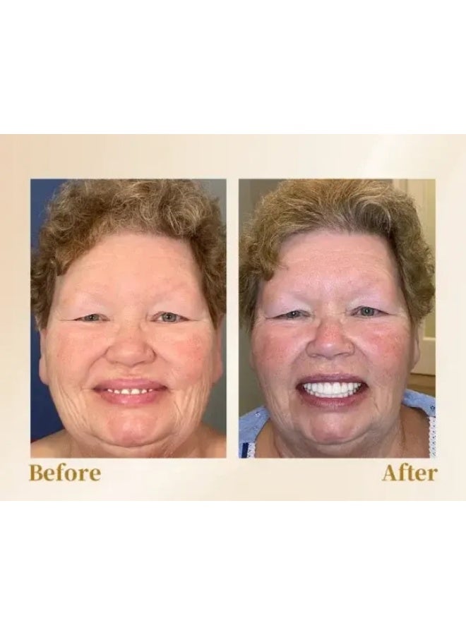 Feimuko Comfortable Fit, Natural Look, Easy Care - Professional Dental Resin Denture Repair & Refinement Kit. - Image 5