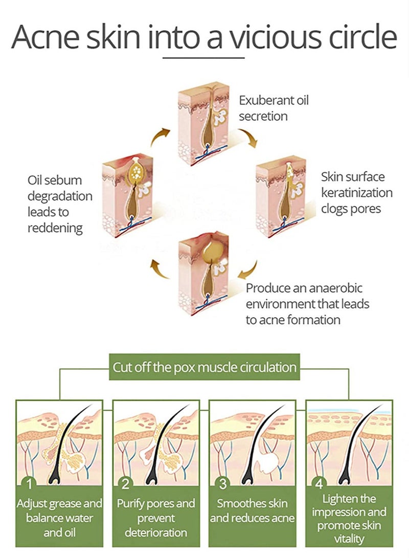 Aichun beauty AICHUN BEAUTY Anti-Acne Facial Serum Aloe Vera Extract Salicylic Acid Repairs Damaged Skin 30ml, Scar Removal Facial Serum Pimples Stretch - Image 5