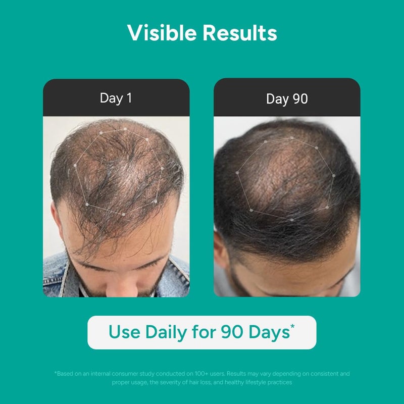 Arata Hair Growth Serum Concentrate with 3 Redensyl 3 Procapil 5 Kopexil Caffeine and Rice Water No Minoxidil Supports Hair Growth Helps Reduce Hairfall Serum For Women and Men 30 ML - Image 2