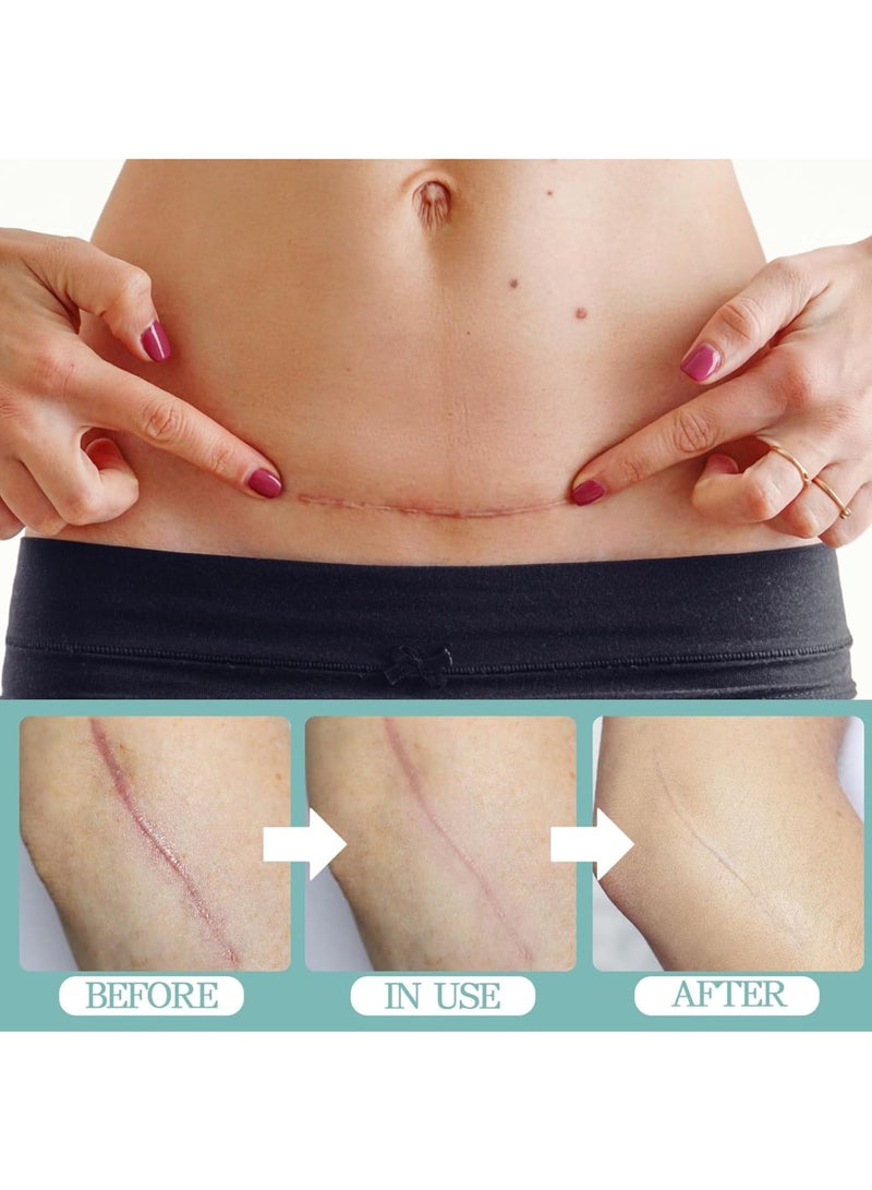 KASTWAVE KASTWAVE Scar Gel, Fades Stretch Marks Away, Scar Removal Cream for Surgical Scars, Burns, Acne, Keloid Bumps,C Section Scars, For Adults & Kids, 50ml  - Image 5