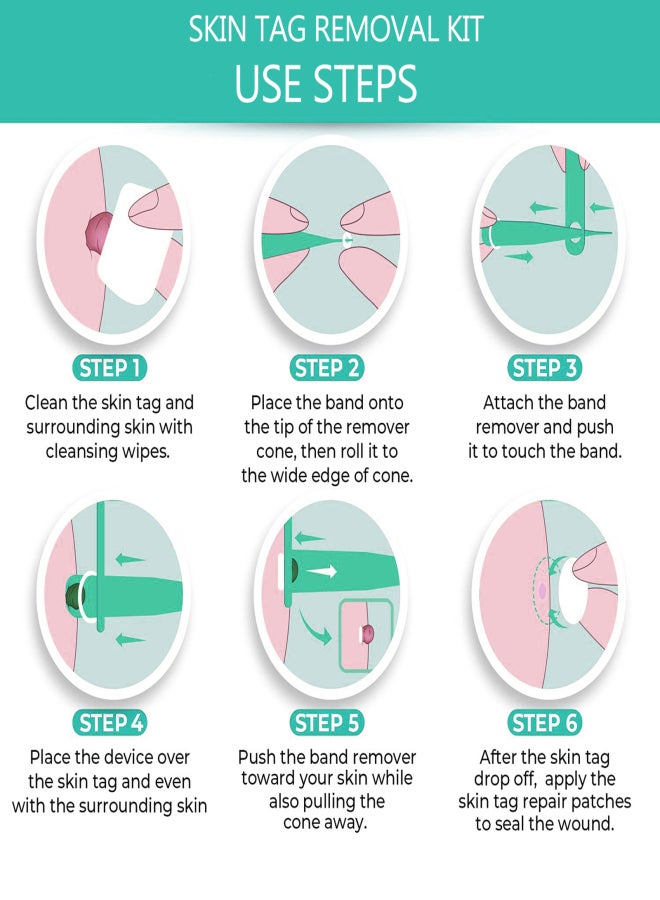 2-4MM/4-8MM Skin Tag Removal Kit Skin Tag Remover Skin Mole Wart Remover Micro Band Skin Tag Removal Kit with Cleaning Pads Mole Face Care - Image 3