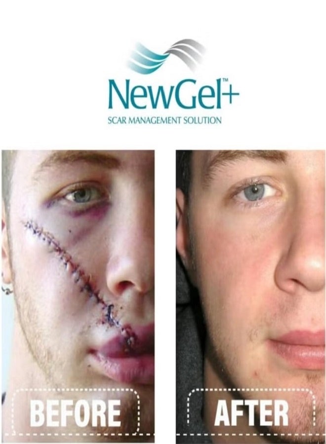 New Gel+ جل سيليكون طبي متقدم + فيتامين E لجميع أنواع الندبات 15 جرام - Image 5