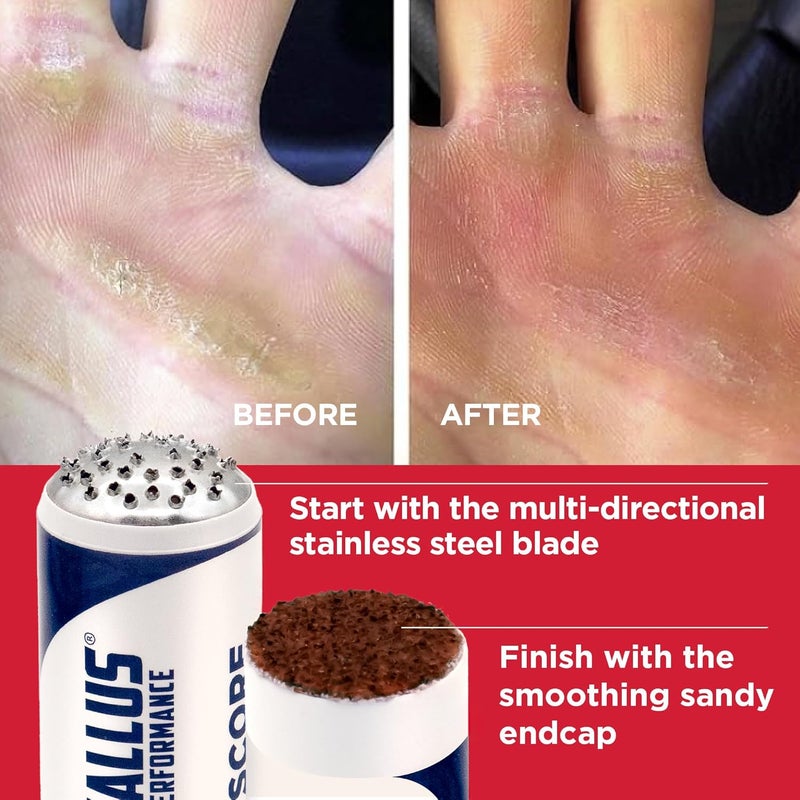 Callus Performance Callus Score – Precision Hand Callus Remover for Athletes | Prevents Ripping | Callus Management for Weightlifters, Cross Training, Gymnastics and More | - we just do calluses - Image 1