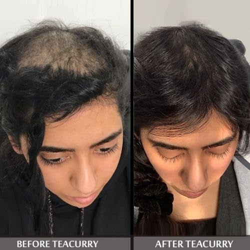 TEACURRY شاي تيكاري المضاد للصلع عبوة شهرين 200 جرام يساعد في الصلع النمطي الذكوري - Image 3