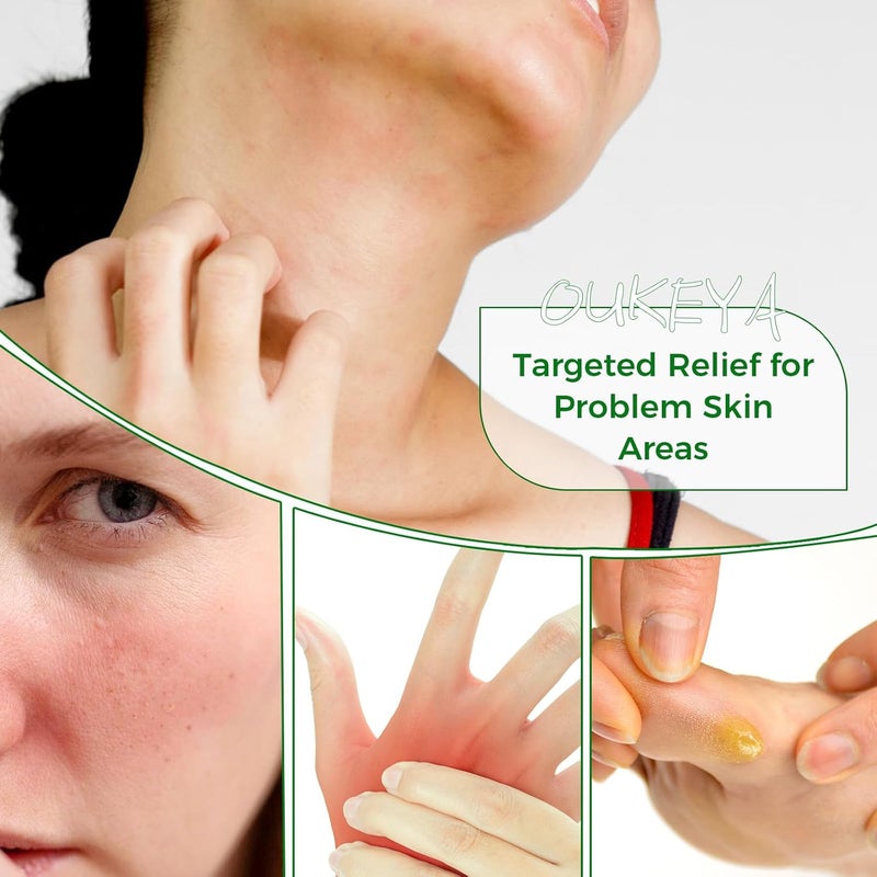 OUKEYA Tea Tree Oil Balm All Natural Tea Tree Balm Soothe Skin Discomfort And Moisturize Dry Skin On Hands Feet And Body Acne Eczema  Psoriasis Relief 282 oz - Image 4