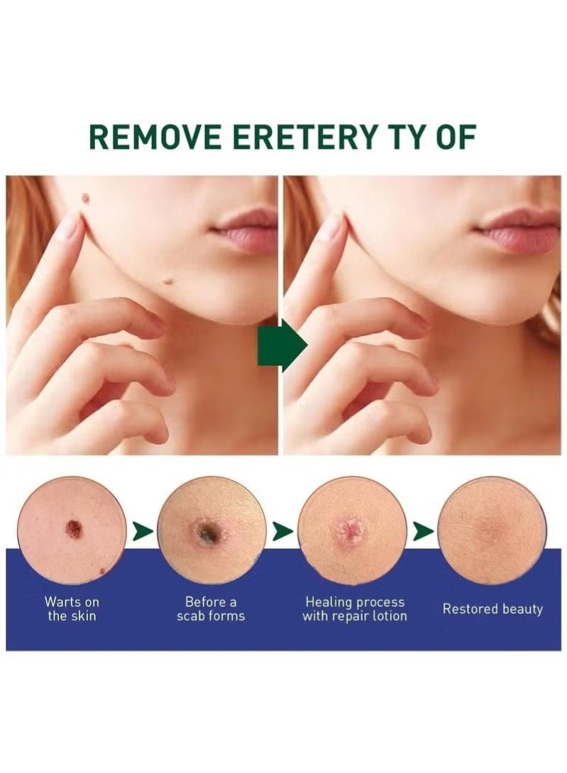 Lanthome Wart Remover, Fast Acting and Painless Skin Tag Remover Liquid, Tags and Mole Remover, Tag-Remover for Hands and Body, Wart Cream for Genital Warts, Plantar Wart, Common Wart, Corn, Flat Wart - Image 2