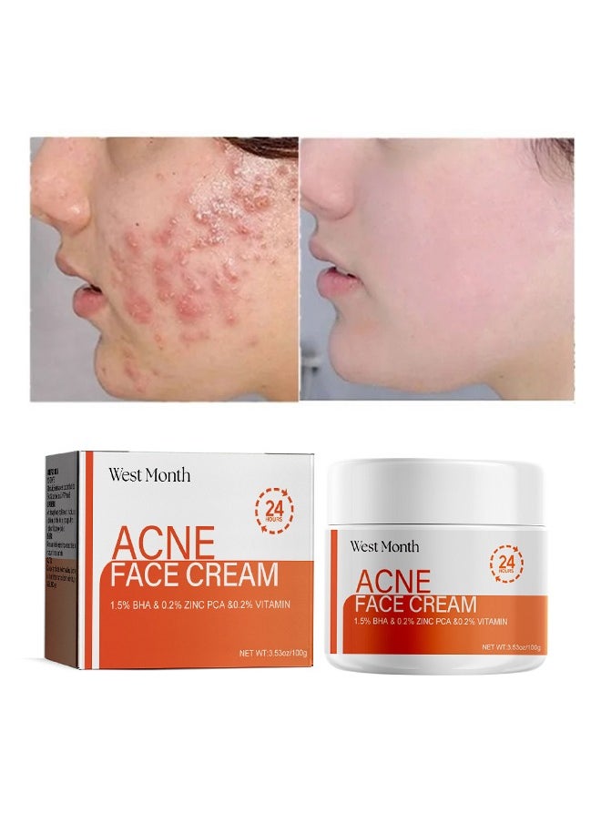 West&Month Acne Face Cream 100g, Acne Spot Treatment for Face & Acne Dots, Natural Cystic Acne Treatment, For All Skin Types, Premium Acne Scar Cream & Pimple Remover 100g  - Image 1