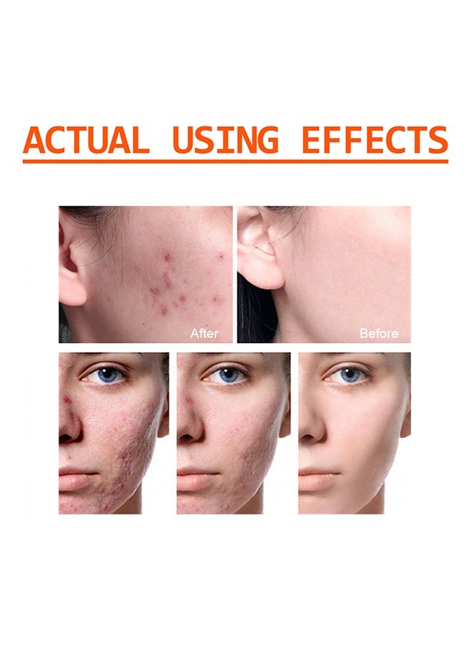 West&Month Acne Face Cream 100g, Acne Spot Treatment for Face & Acne Dots, Natural Cystic Acne Treatment, For All Skin Types, Premium Acne Scar Cream & Pimple Remover 100g  - Image 3