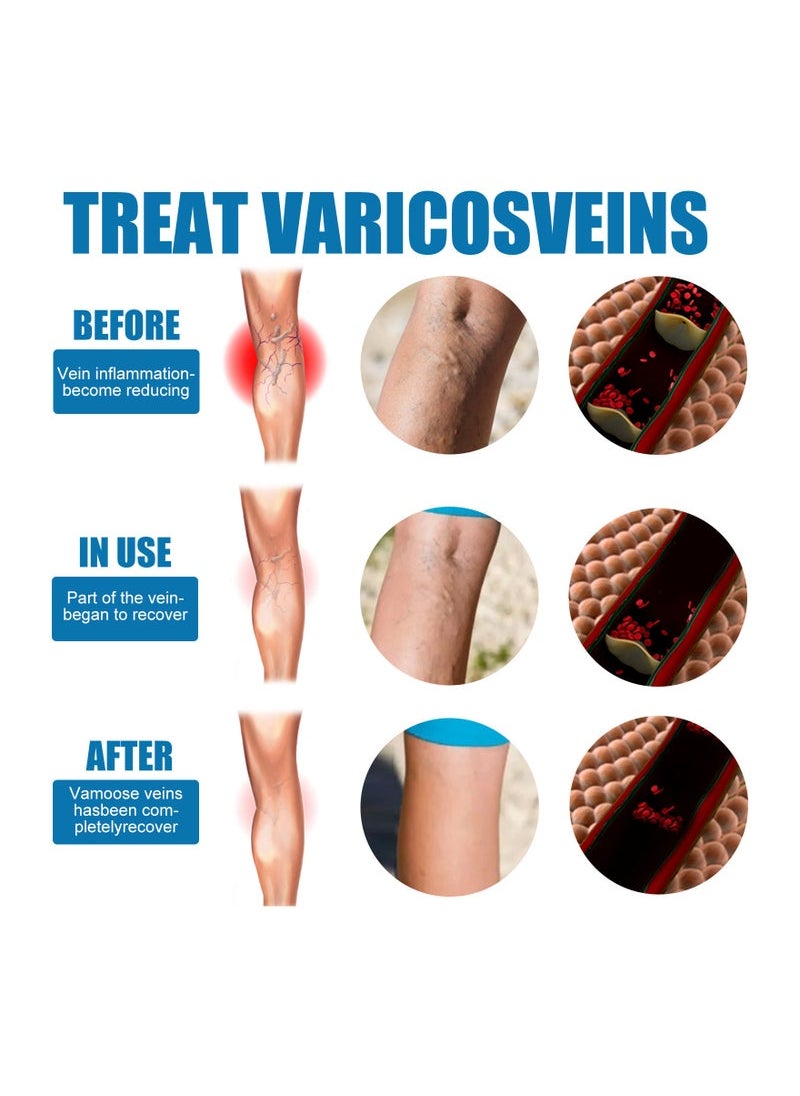 SOUTH MOON Veinhealing Varicose Veins Treatment Spray  - Image 5