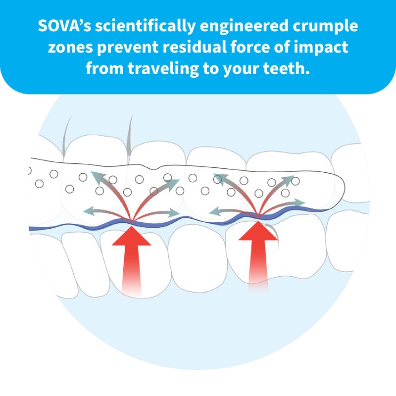 SOVA Aero Night Guard - 1.6mm Thin - Custom-Molded Fit - Protects Against Nighttime Teeth Grinding & Clenching - Odor & Taste Free - Remoldable Up to 20 Times - Non Toxic - Image 5