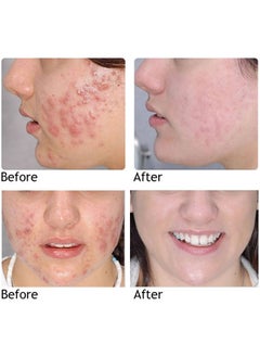 AuQuest Acne Remoyal Gure Gel -Herbal Acne Treatment Cream Pimple Spot Removal for Teens Oil Control Acne Scar Gel Shrink Pores Skin Care Beauty Health 20g  - Image 5