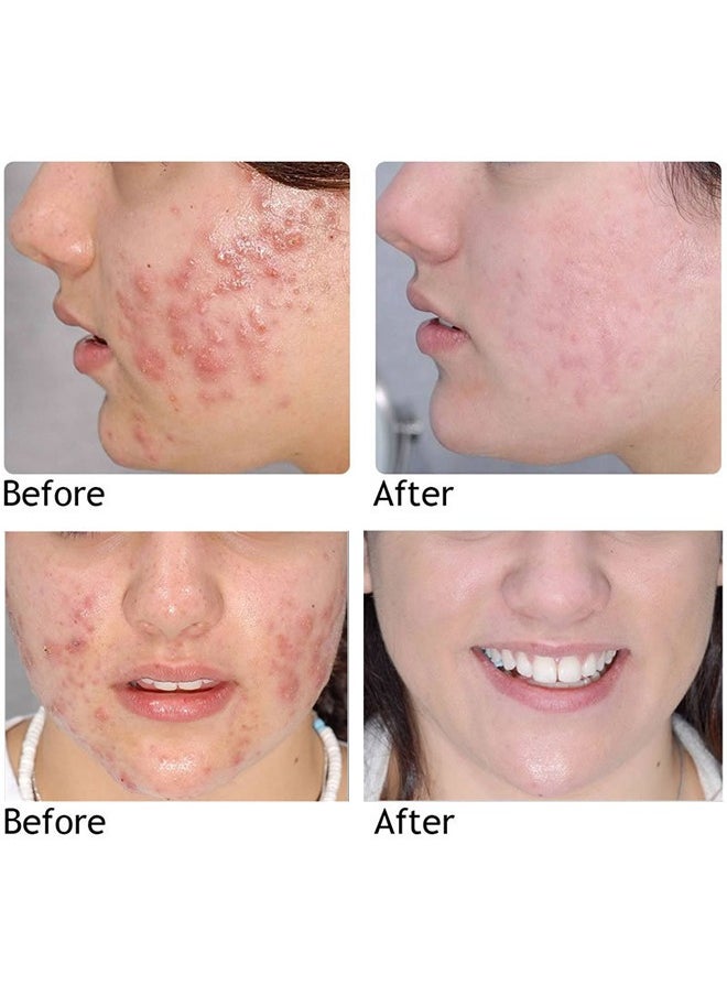 AuQuest - Acne Remoyal Gure Gel -Herbal Acne Treatment Cream Pimple Spot Removal for Teens Oil Control Acne Scar Gel Shrink Pores Skin Care Beauty Health 20g - Image 1