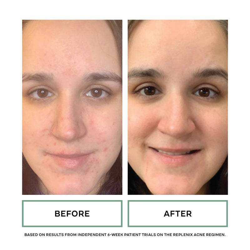 Replenix Gly-Sal Clarifying Acne Pads, 60 Count, Medical-Grade Glycolic Acid & 2% Salicylic Acid Exfoliating Pads for Acne-Prone Skin, Help Clear Blemishes & Refine Pores, Non-Oily - Image 5