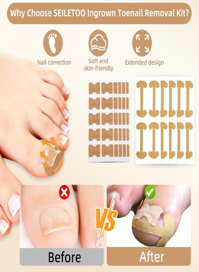 SEILETOO Ingrown Toenail Corrector Set with Breathable Correction Strips, Upgraded Ingrown Toenail Treatment Kit, Curved Toenails Corrector Patch, Pedicure Tools, for Home Use Women Man - Image 3