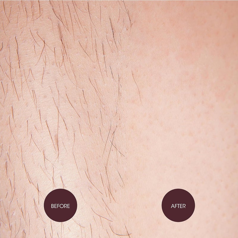 Nad's مجموعة شمع البكيني البرازيلية من نادز خالية من الشرائط شمع صلب مجموعة إزالة الشعر الحميمة تشمل 3 ملعقات خشبية 3 x مناديل زيت شمع ساخن 140 جرام - Image 5