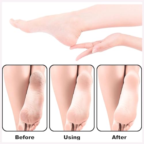 TRITON Professional Double Sided Emery Pads Foot Scrubber Rasp File Buffer Scraper Reduces Corns, Calluses, Rough, Hard, Dry, Cracked, Dead Skin_White - Image 5